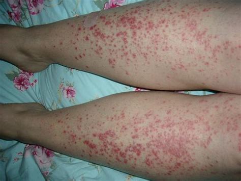 Guttate Psoriasis Causes Symptoms Treatment Pictures Cure Home