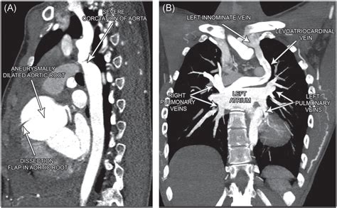A Contrast‐enhanced Computed Tomography Showing Ascending Aortic