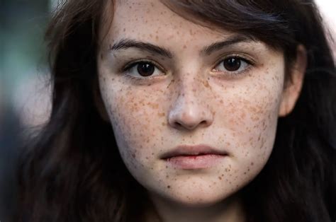 3 Simple Ways To Get Rid Of Freckles