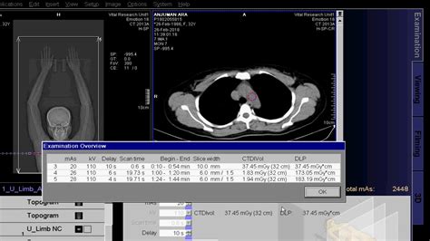 Ct Scan Of Upper Limb Angio Youtube