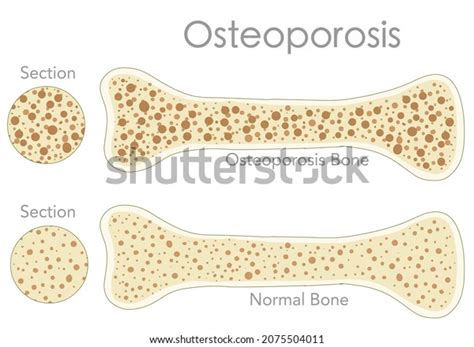 Porous Bone Osteoporosis Bone Cross Section Stock Vector Royalty Free