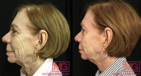 Thermage Before And After Photos Skin Tightening Patient Photo