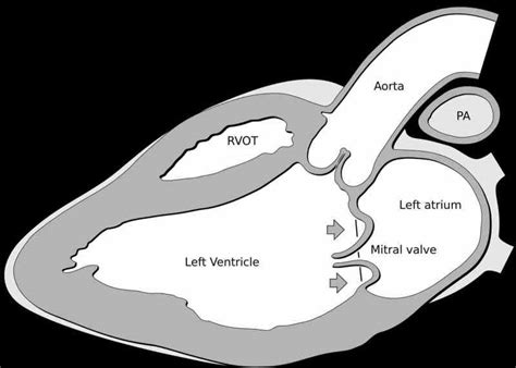 Figure Mitral Valve Prolapse Contributed By Statpearls Ncbi