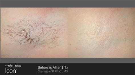 Laser Hair Removal Montrose Permanent Hair Reduction