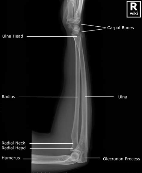 Radiographic Anatomy Forearm Lateral Radiology Student Anatomy