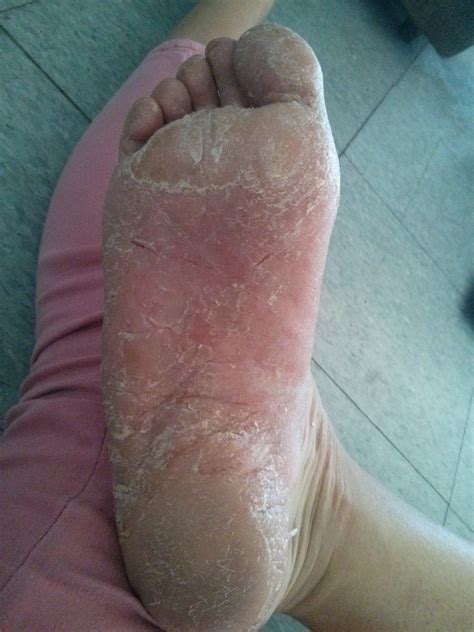 Living With Dyshidrosispompholyx Peeling Badly Signs Of Third Outbreak