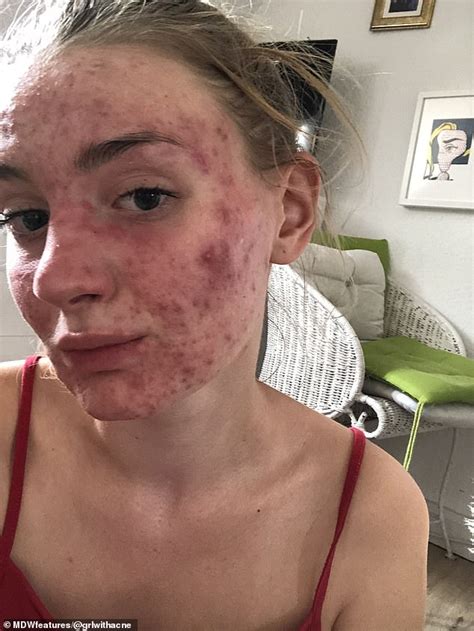 Woman Who Had Cystic Acne So Severe That It Affected Her Sight Celebrity Wshow