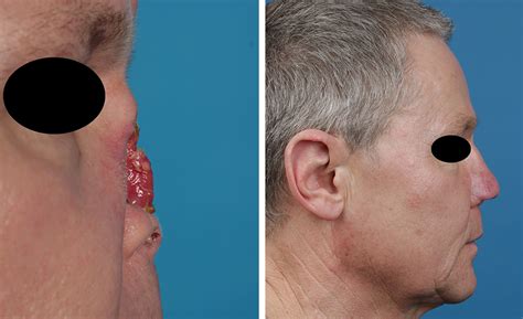 Nasal Reconstruction Dr Gassner