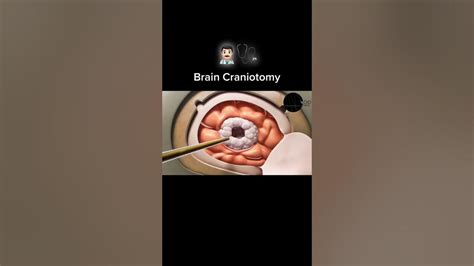 Brain Craniotomy Anatomy Youtube