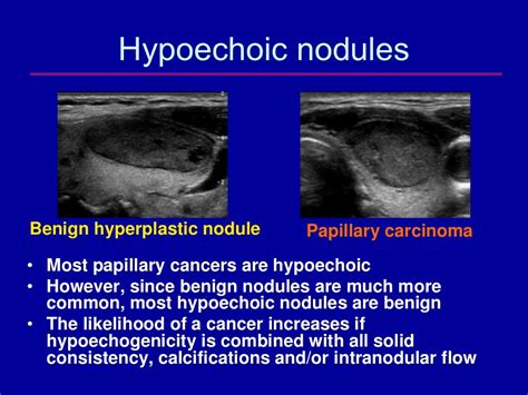 The Epidemic Of Thyroid Nodules Which Should Undergo Fine Needle Asp