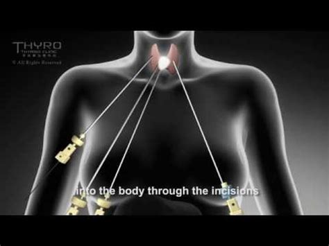 Minimally Invasive Thyroidectomy Thyroid Thyroid Cancer Goiter