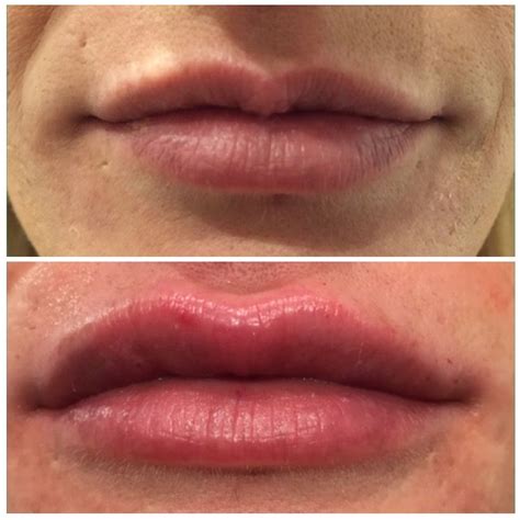 We did not find results for: Lip Fillers #lips #fillers #beautiful #juvederm | Lip ...