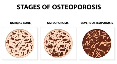 What is the difference between osteopenia and osteoporosis. Osteoporosis vs. Osteopenia