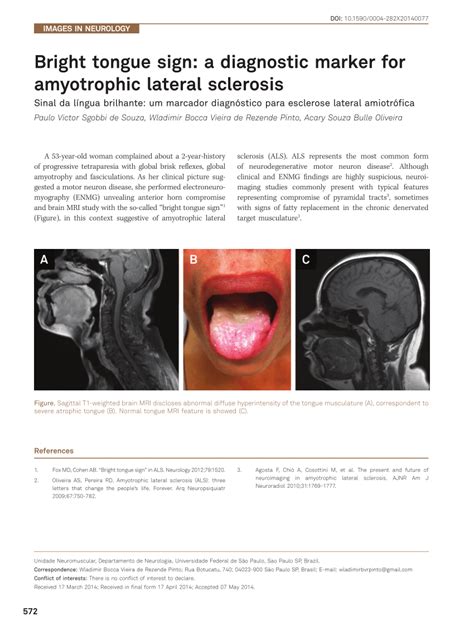 Pdf Bright Tongue Sign A Diagnostic Marker For Amyotrophic Lateral