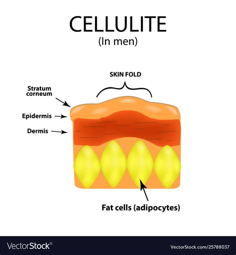 Skin Aging In Men Cellulitis Infographics Vector Image