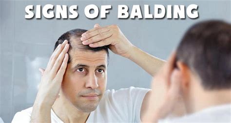 Apr 26, 2021 · a visible scalp: Signs Of Balding - How To Know If You're Going Bald?