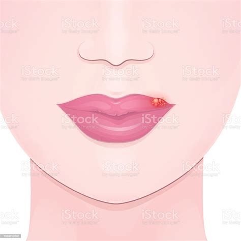 Cold Sore Lip Stock Illustration Download Image Now Herpes Human
