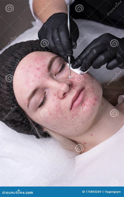 Mechanical Facial Cleansing Stock Image Image Of Female Medicine