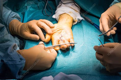 Hand Surgery Stock Image C0349750 Science Photo Library