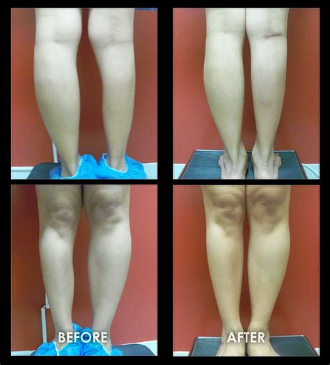 Male And Female Calf Implants Images Before And After Galleries