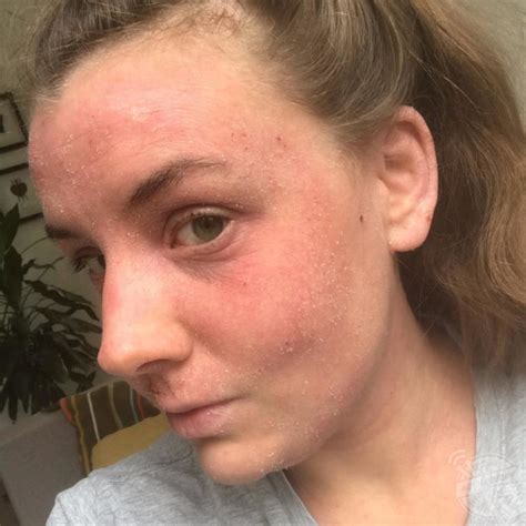 This Womans Severe Eczema Has People Worried Shes Contagious But It