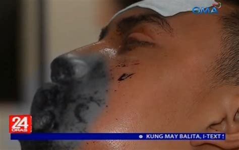 Vapes Or E Cigarette Explode At Mans Mouth Where In Bacolod