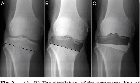 Figure 1 From Uni Condyle High Tibial Osteotomy For Malunion Of Medial