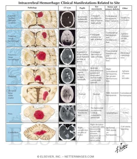 Brain Bleed Brain Bleed Locations
