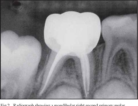 [pdf] use of nickel titanium rotary files for root canal preparation in primary teeth