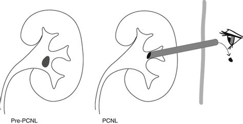 Core Urology For Surgical Trainees Pcnl Percutaneous Nephrolithotomy