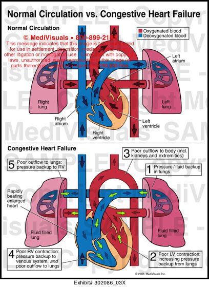 Right Sided Heart Failure Animated Normal Circulation Vs