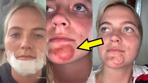 Womans Face Gets Infected After Kissing A Man With Stubble Youtube