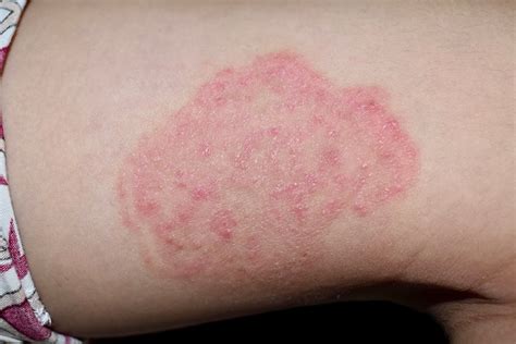 Fungal Infections Of The Skin Tinea Capitis And Tinea Versicolor And