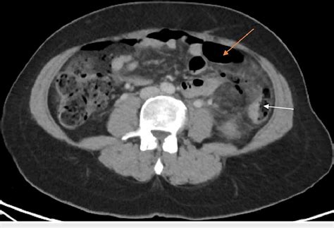 Ct Abdomenpelvis Without Contrast Axial Image Showing A Moderate