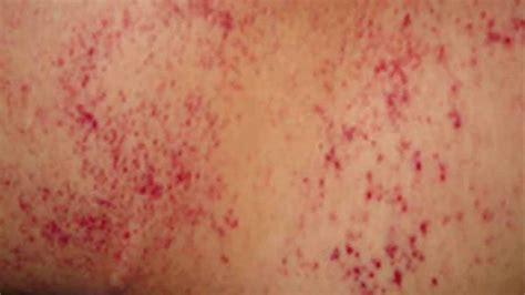Tiny Pinpoint Red Dots On Skin Caused By Viruses Docuwest