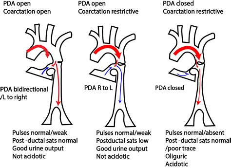 Coarctation Of The Aorta In A Neonate Critical Care Sonography
