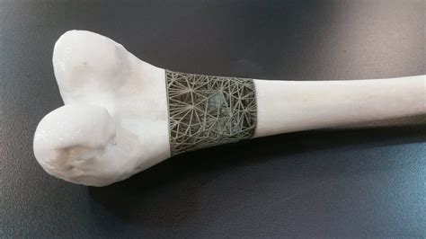Clinical Applications Of 3 D Printing In Orthopaedic Care Orthopaedic