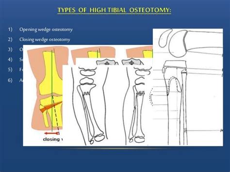Percutaneous Drilling Tibial Osteotomy For Correction Of Genu Varum I