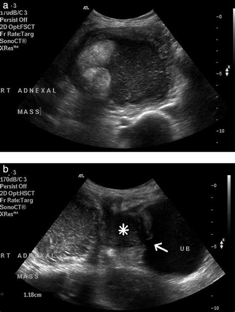 Mature Ovarian Dermoid Cyst Invading The Urinary Bladder Tandon
