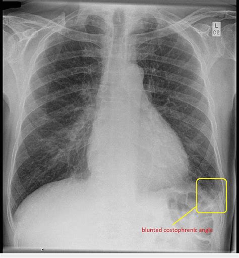 Chest X Ray Chest X Ray Showing Mildly Blunted Left Costophrenic Angle