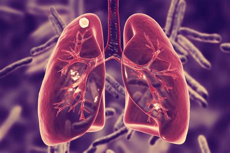 Qué es la tuberculosis pulmonar y cuáles son sus síntomas Mejor con