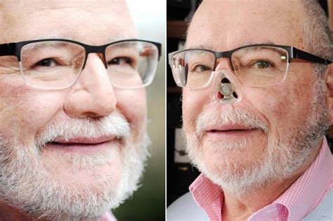 Cancer Op Man Fitted With Magnetic Nose After Losing His Real One