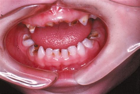 Dental Disease In Children With Chronic Illness Archives Of Disease