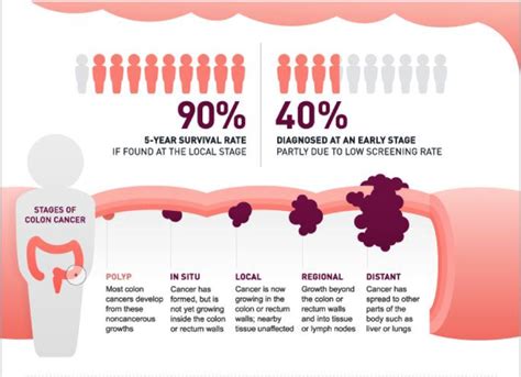 What Is Colon Cancer Health Life Media