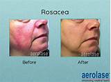Photos of Laser Treatments For Rosacea On Face