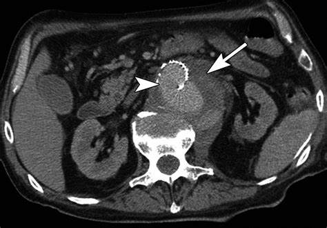 Spectrum Of Ct Findings In Rupture And Impending Rupture Of Abdominal