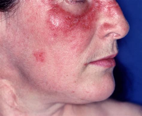 B Cell Depletion Therapy With Rituximab Effective For Cutaneous Lupus