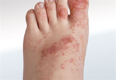 Rash Relieve Foot Pain And Leg Pain