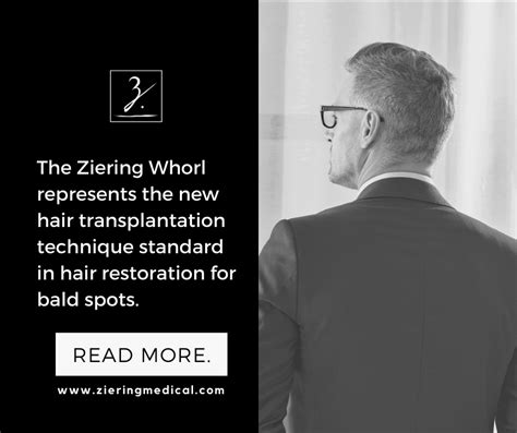 Are Hair Whorls Bald Spots Ziering Medical