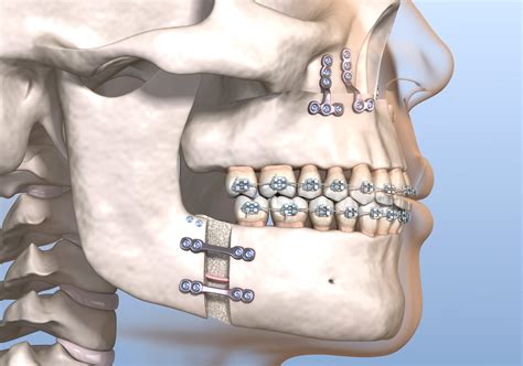 Jaw Surgery Ab Dental Costa Rica